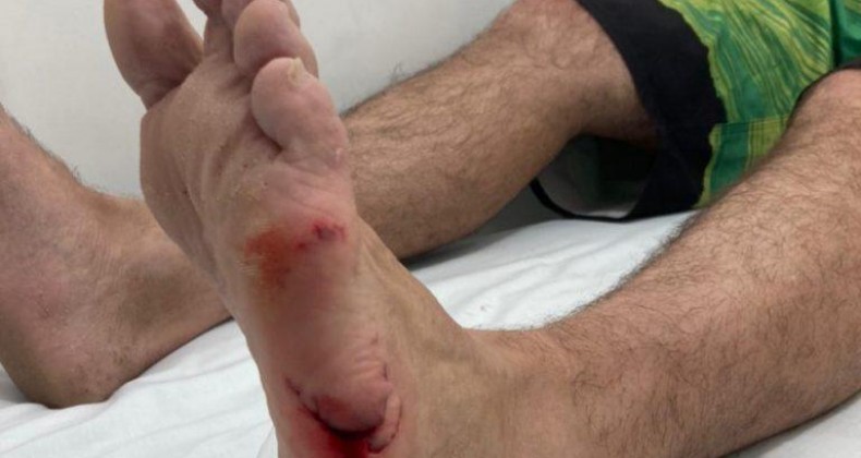Surfista é atacado por animal marinho em Navegantes