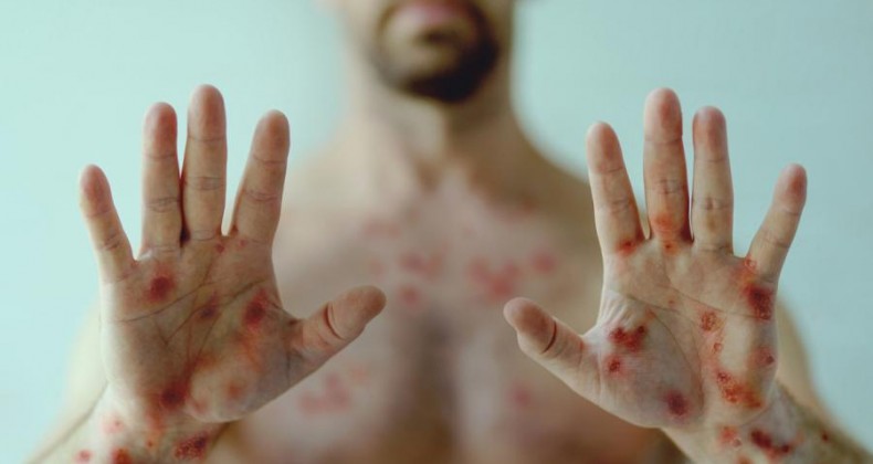 SC faz aquisição emergencial de insumos para teste da varíola dos macacos